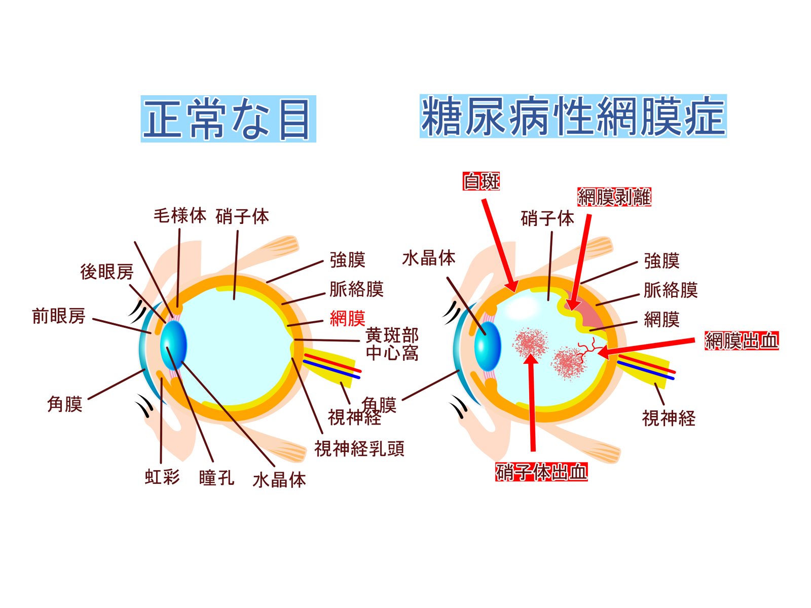 糖尿病網膜症の原因